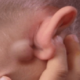 Что делать если за ухом появилась шишка
