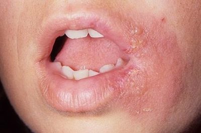 Герпетическая сыпь на губе