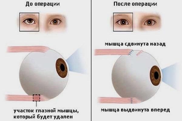 Операция по коррекции мышц глаза